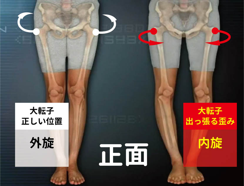 大転子を引っ込める方法 太もも横の出っ張りを解消する深層外旋六筋トレーニング Qitano キタノ カラダづくりラボ