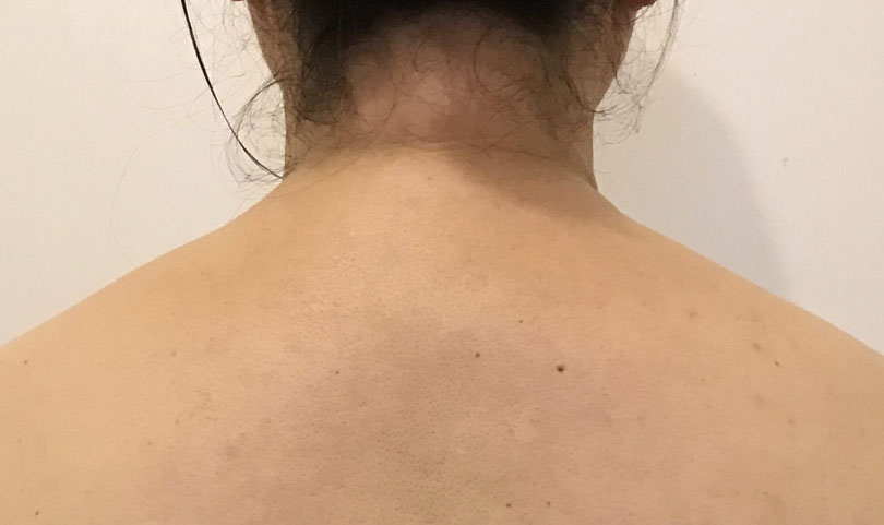 首の後ろに脂肪が溜まる原因と対策！効果的なストレッチと生活習慣